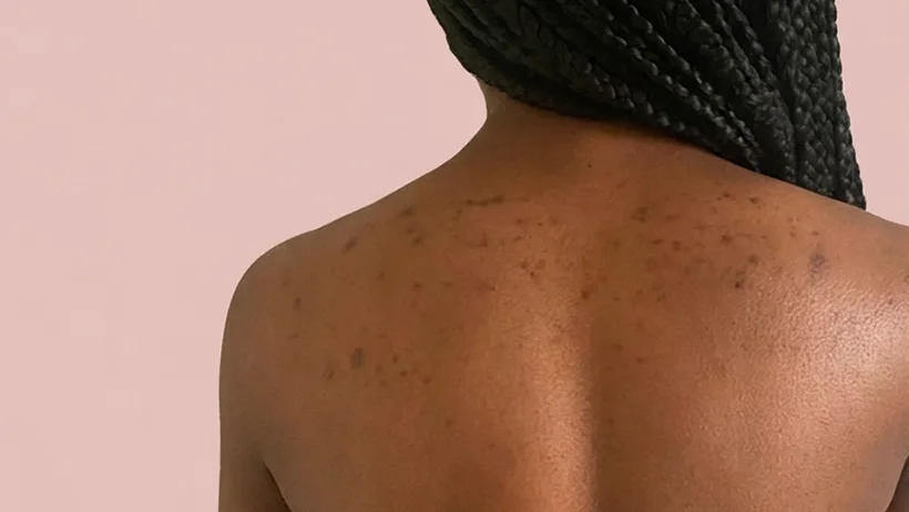 Back with post-acne marks