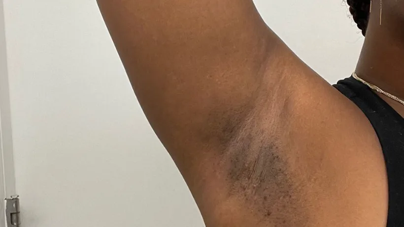 Underarm with darker-looking skin